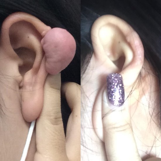 คีลอยด์