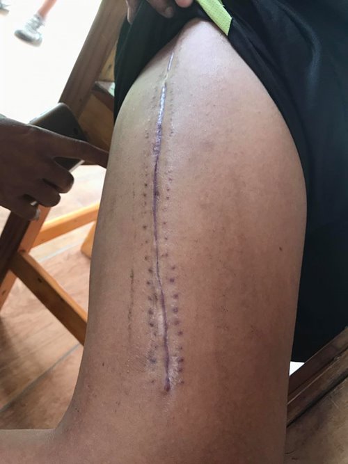 ผู้กองเป๊กยอมจ่ายเงินเยียวยาแม่ทหารขาหัก ด้านแม่ลั่นไม่อยากเจอทหารอีกแล้ว 