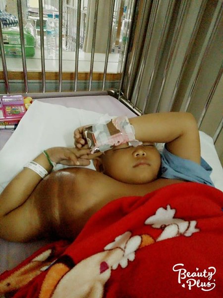 มะเร็งกระดูก