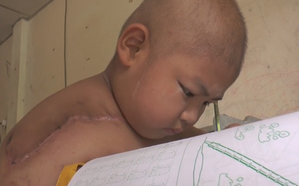 มะเร็งกระดูก