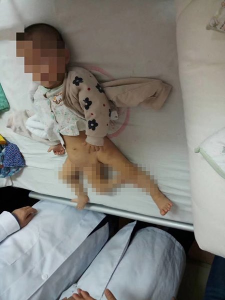 แฝดปรสิต