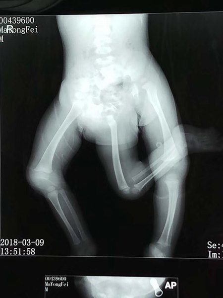 แฝดปรสิต