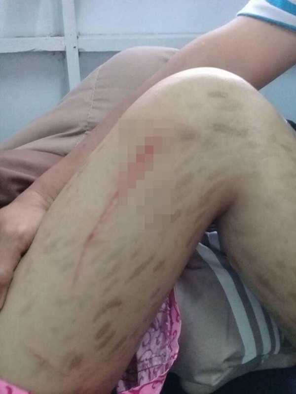 พี่เลี้ยงทำร้ายเด็กตาบอด