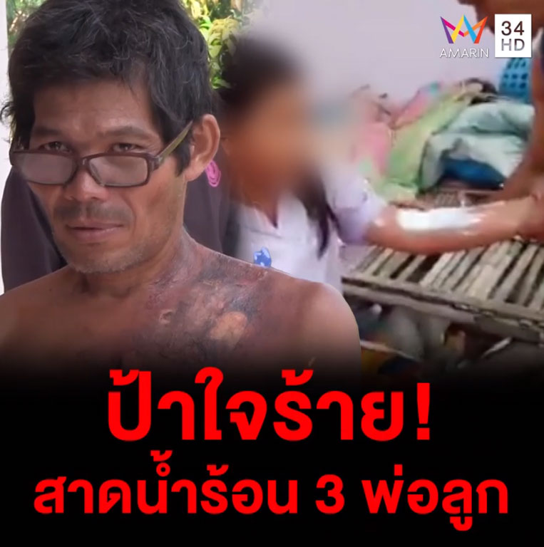 ป้าแท้ ๆ สาดน้ำร้อนใส่ 3 พ่อลูก