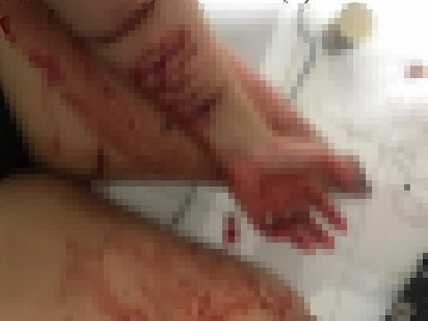 กรีดแขนตัวเอง