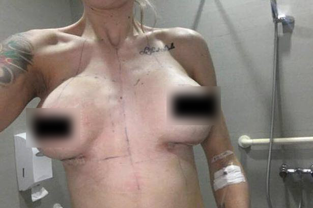 ศัลยกรรมหน้าอก