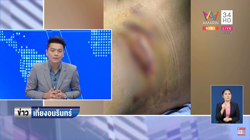 ศัลยกรรมนมเน่า