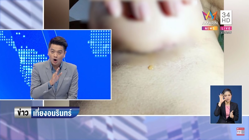 ศัลยกรรมนมเน่า