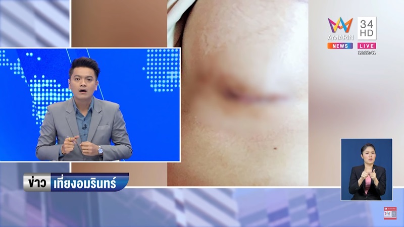 ศัลยกรรมนมเน่า