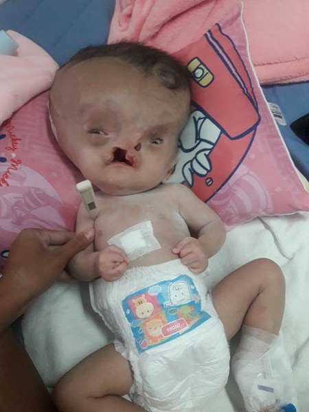 น้องผักบุ้ง เด็กพิการปากแหว่งเพดานโหว่