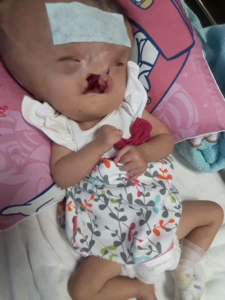 น้องผักบุ้ง เด็กพิการปากแหว่งเพดานโหว่