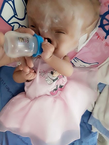 น้องผักบุ้ง เด็กพิการปากแหว่งเพดานโหว่