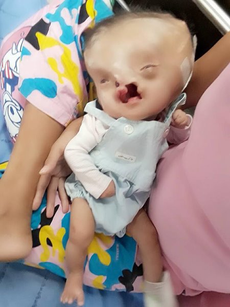 น้องผักบุ้ง เด็กพิการปากแหว่งเพดานโหว่