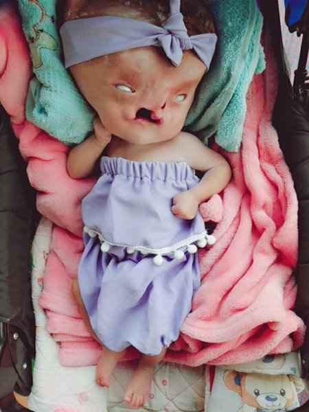 น้องผักบุ้ง เด็กพิการปากแหว่งเพดานโหว่