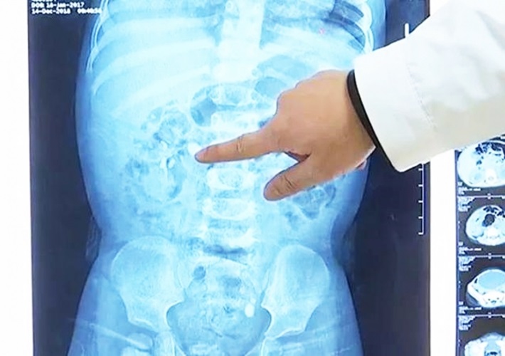 อาหารเสริมทำเด็กไตพัง