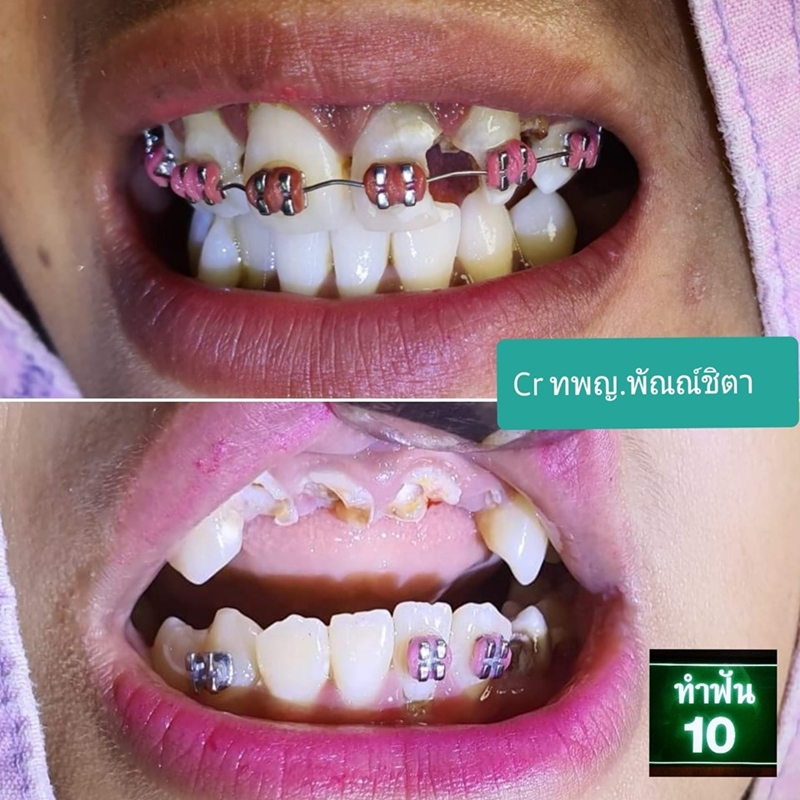 จัดฟันเถื่อน