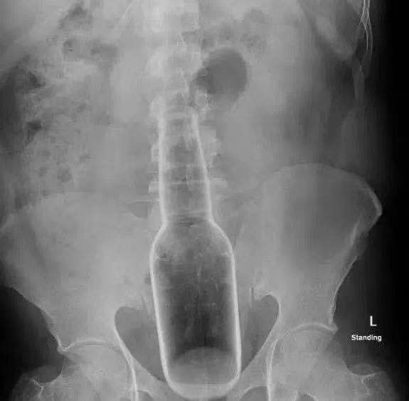 ขวดติดในรูก้น