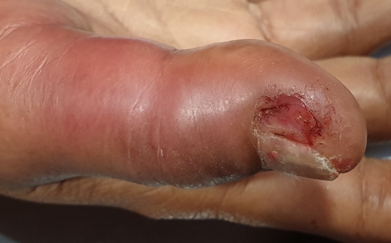 ทำเล็บแฟชั่นเสี่ยงติดเชื้อ