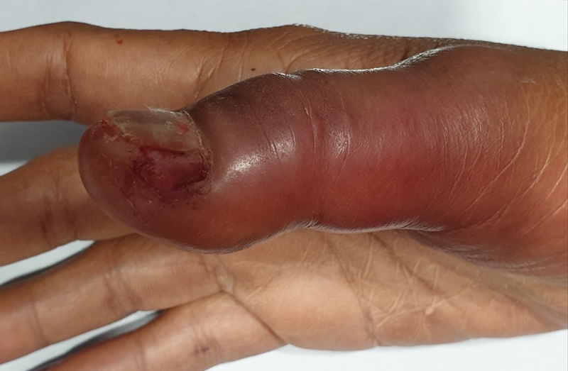 ทำเล็บแฟชั่นเสี่ยงติดเชื้อ