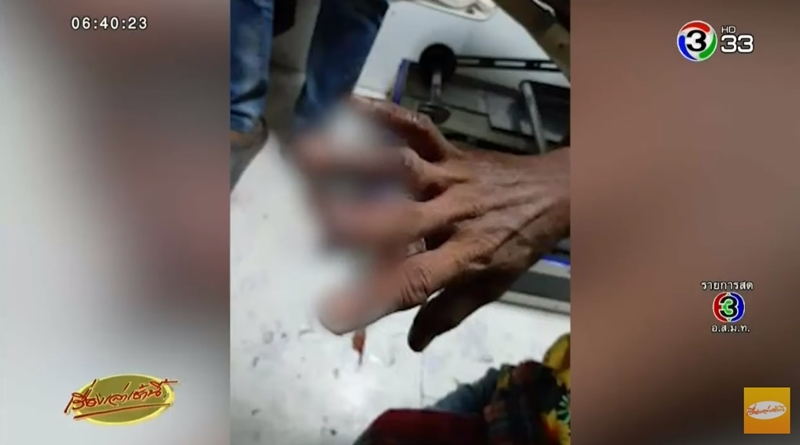 ประทัดระเบิดใส่นิ้ว