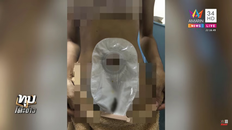 ผ่าตัดแปลงเพศ หมอต่อท่อผิด