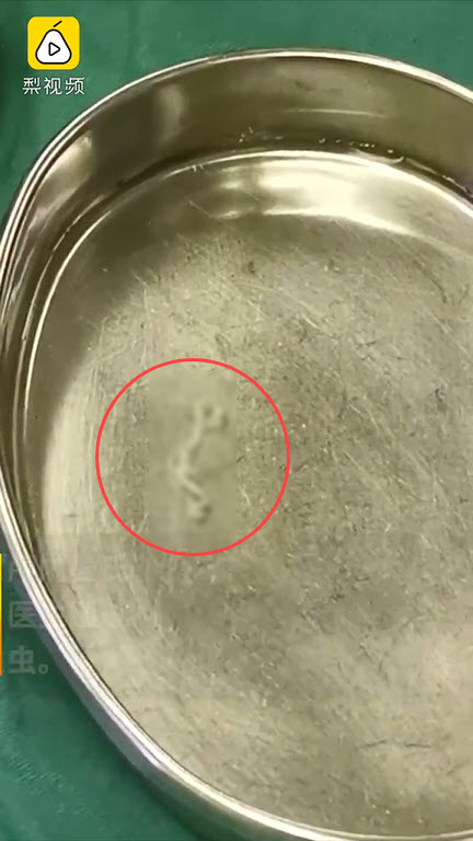 พยาธิไชสมอง