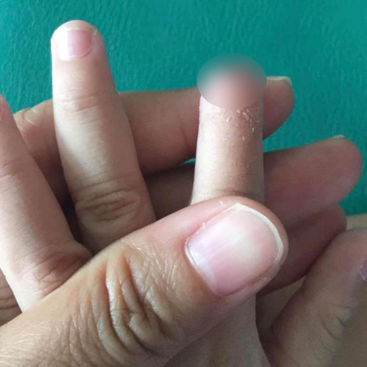 ครูปิดประตูหนีบนักเรียนนิ้วขาด