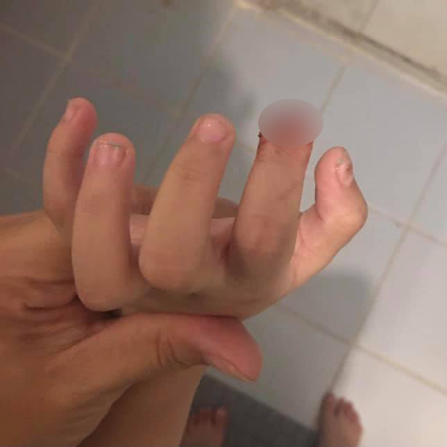 ครูปิดประตูหนีบนักเรียนนิ้วขาด