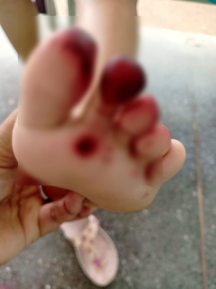 เตือนภัย พิษกิ้งกือ