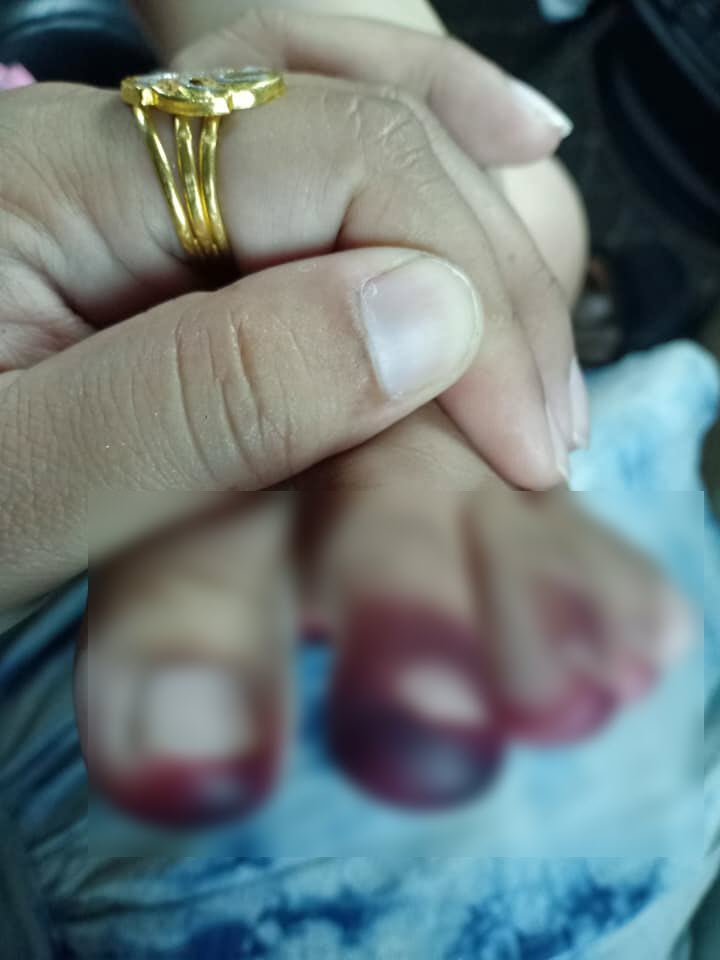 เตือนภัย พิษกิ้งกือ