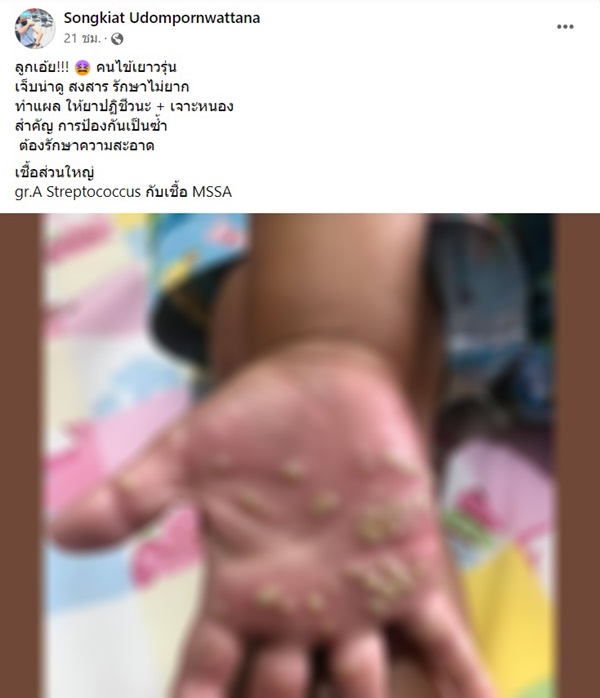 หนองขึ้นมือเด็ก