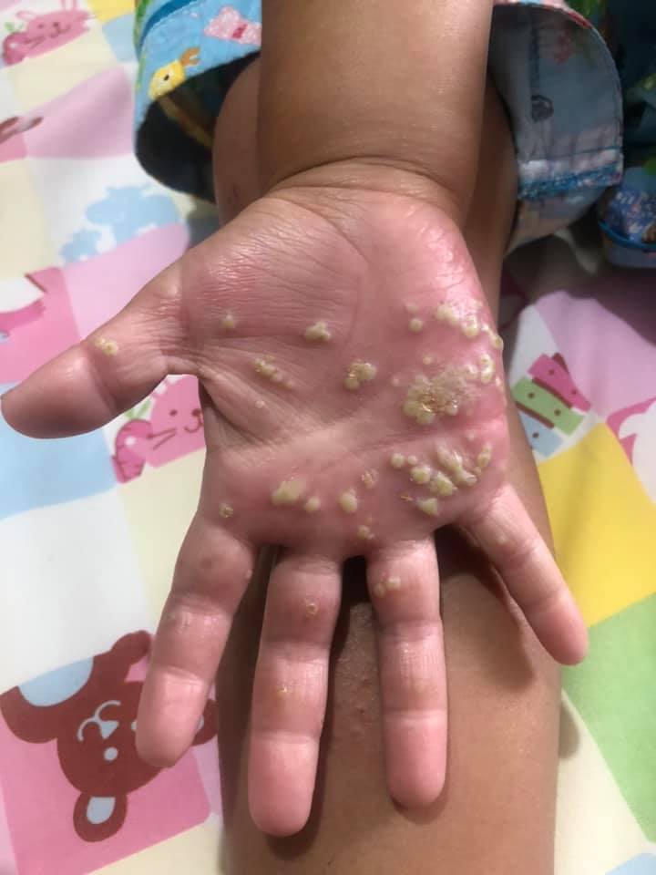 หนองขึ้นมือเด็ก