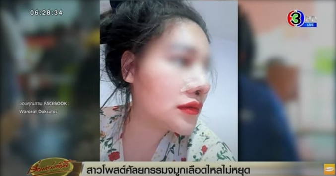 ศัลยกรรมจมูกพลาด