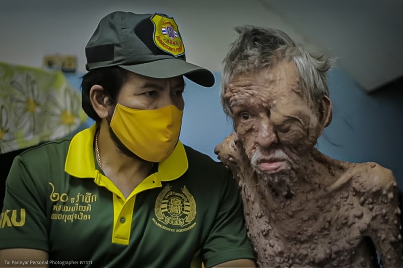 ผู้ป่วยท้าวแสนปม