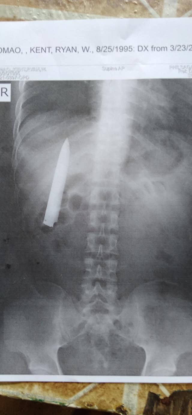 มีดติดอยู่ในอก