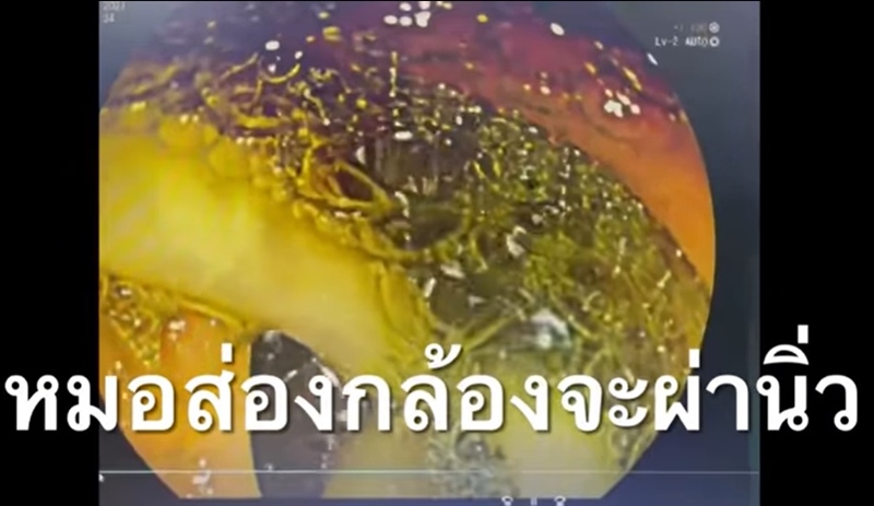 พยาธิไส้เดือน