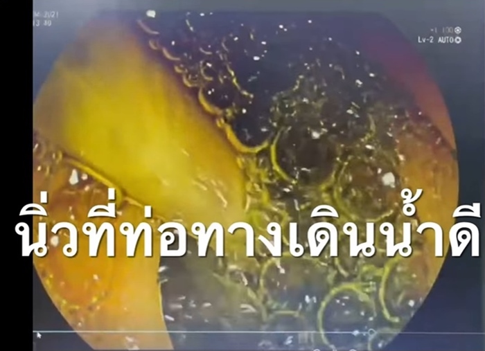 พยาธิไส้เดือน