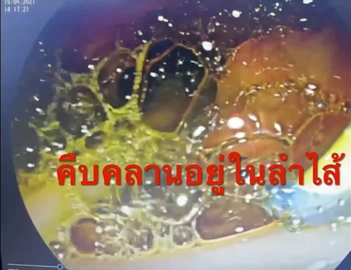 พยาธิไส้เดือน