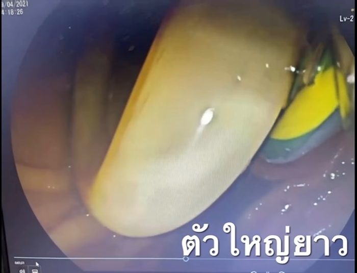 พยาธิไส้เดือน