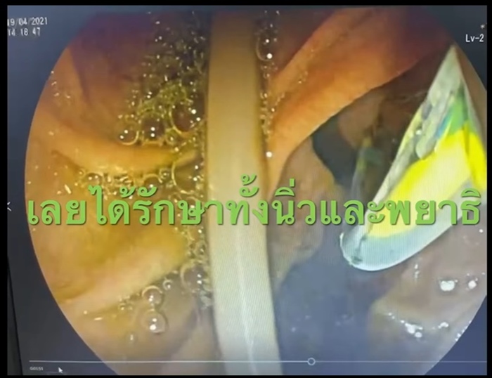 พยาธิไส้เดือน