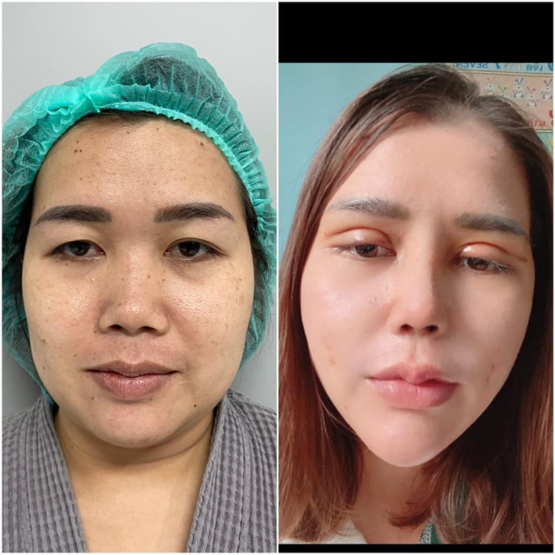 เมียหลวงบุกงานแต่ง ศัลยกรรม