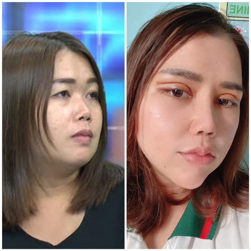 เมียหลวงบุกงานแต่ง ศัลยกรรม