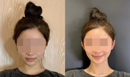 ศัลยกรรมหูเอลฟ์