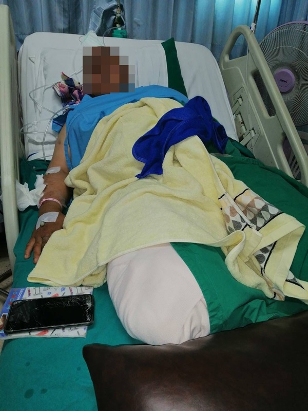 ไรเดอร์ถูกรถชนขาขาด