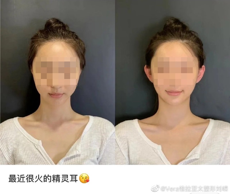 ศัลยกรรมหูเอลฟ์