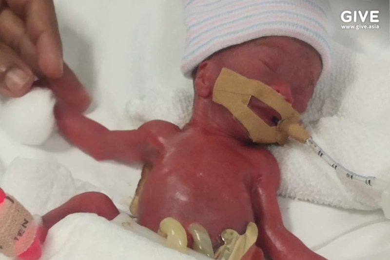 ทารกตัวเล็ก หนัก 2 ขีด