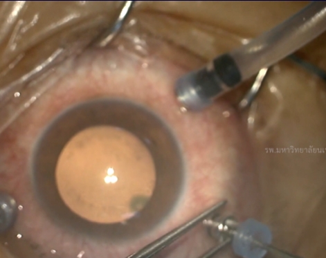 พยาธิไชขึ้นตา