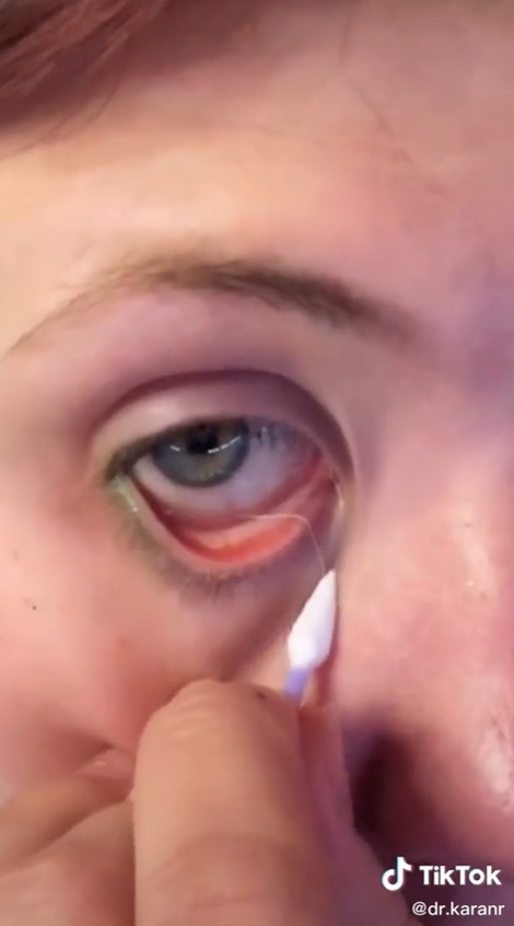 ขี้ตาเป็นเส้น