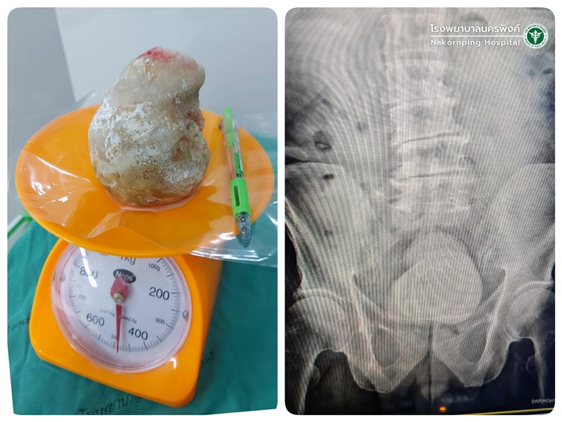 ก้อนนิ่ว