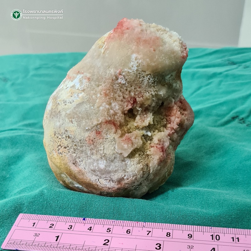 ก้อนนิ่ว